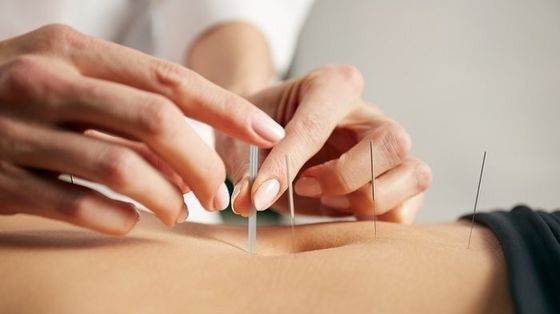 0.16mm Silver Intradermal Acupuncture Needles For  Relief